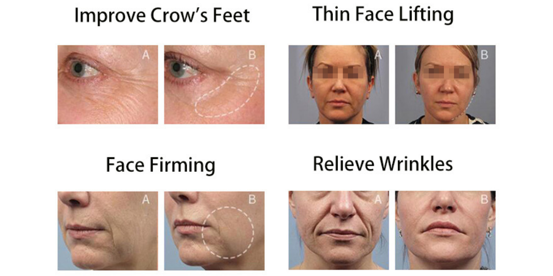 NanoSkin Device - JULIE LINDH